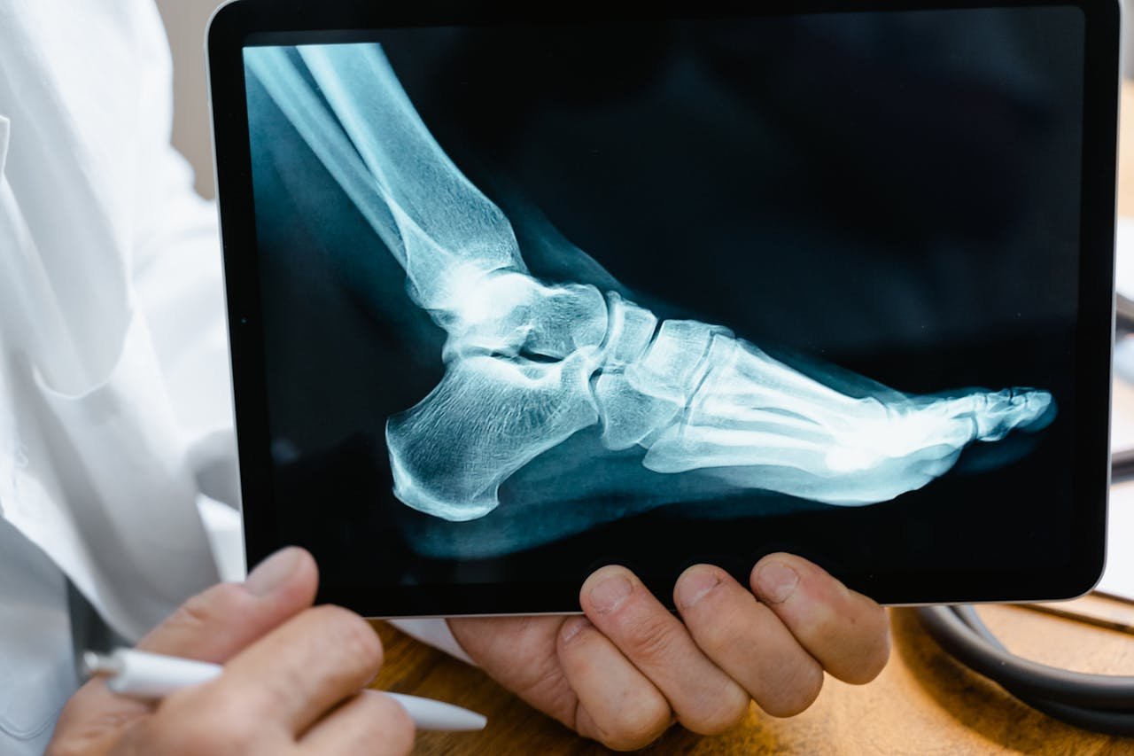 Understanding Avascular Necrosis and Its Impact on Numbness in Extremities